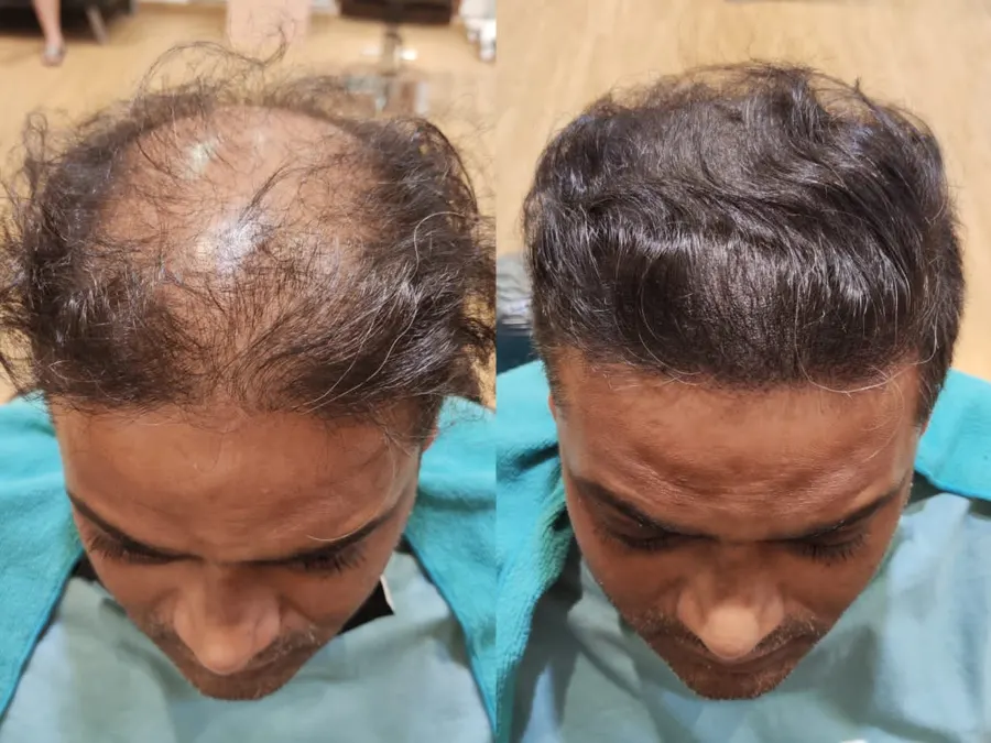 Before and after 1 session
